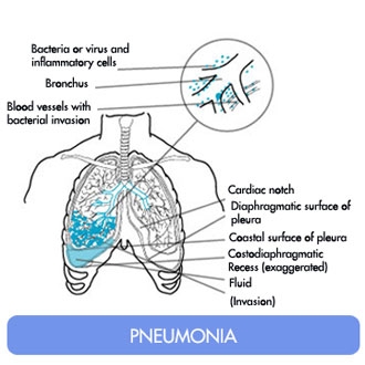 imagine cu pneumoniile infectioase